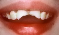 Perfect Smile fractures central incisors